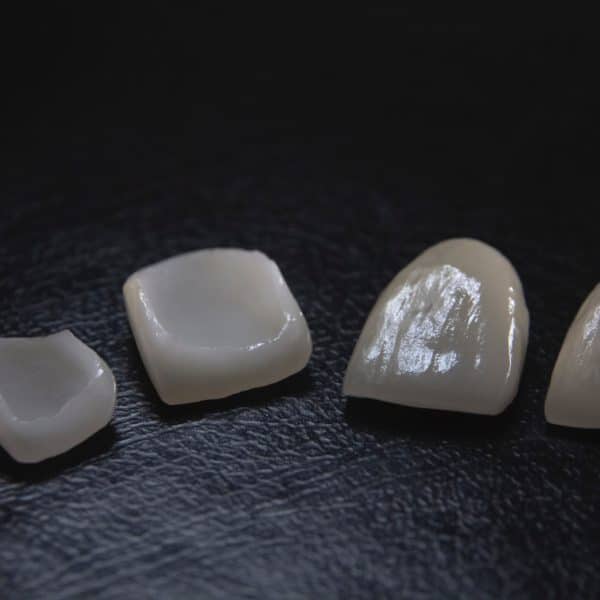 veneers